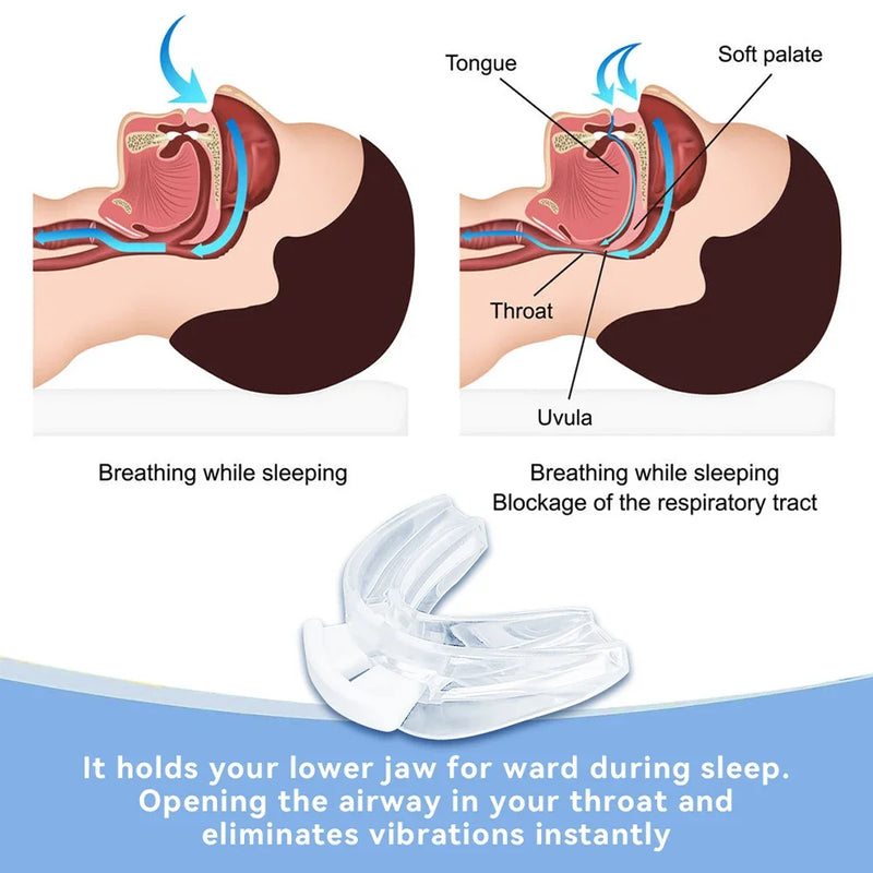 SnoreGuard Silicone Mouthpiece - Top-Rated Sleep Aid for Bruxism & Apnea